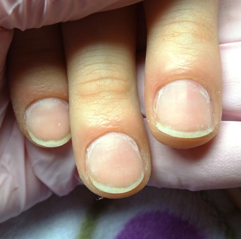 Ногти после аппаратного маникюра. Ямы на ногтях после аппаратного маникюра. Пропилы на ногтях после аппаратного маникюра. Маникюр на погрызанные ногти.